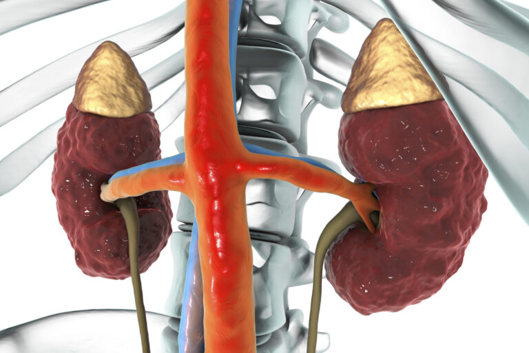 Kidney Image Chronic kidney disease